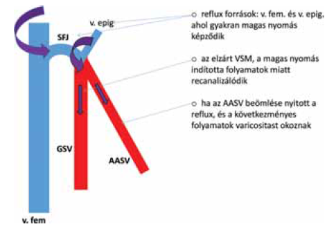 Crossectomia lézerrel