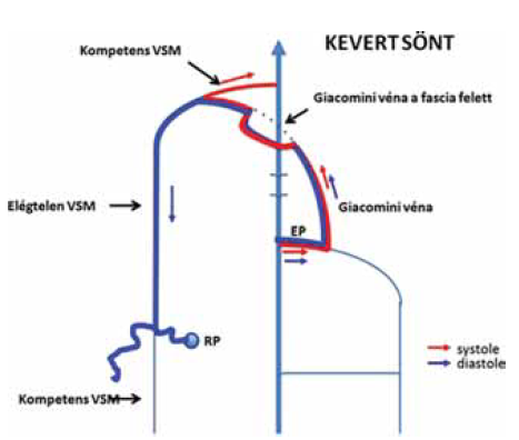 A krónikus vénás elégtelenség haemodynamikai ultrahang-térképezése: a söntök koncepciója