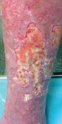 A nem gyógyuló (krónikus) sebek súlyos szövődménye: a biofilm