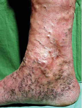 Corona phlebectatica paraplantaris.