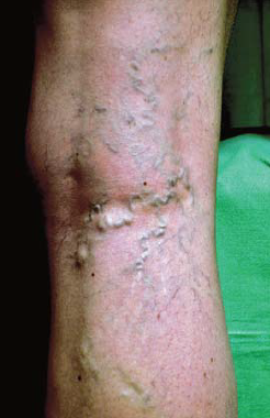 Reticularis varicositas.