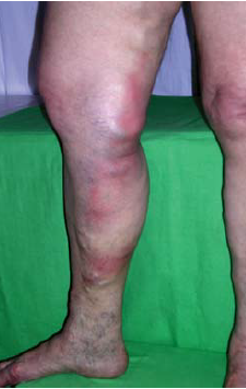 Súlyos varicositas talaján kialakult varicophlebitis.