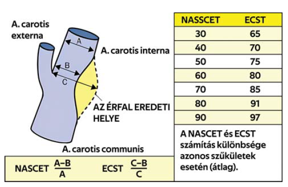Szakmai irányelv az extracranialis artéria carotis interna szűkület invazív ellátásáról