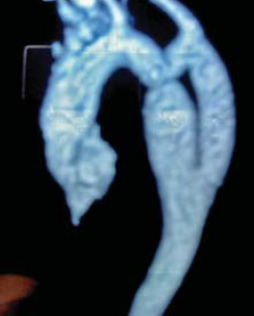 Aorta coarctatiok késői reoperációja