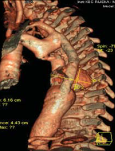 Aorta coarctatiok késői reoperációja