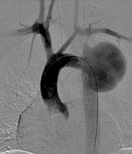 Aorta coarctatiok késői reoperációja