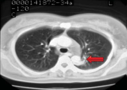 Aorta coarctatiok késői reoperációja