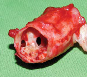 Aorta coarctatiok késői reoperációja