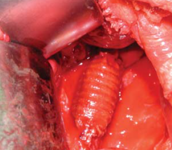 Aorta coarctatiok késői reoperációja