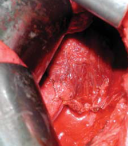 Aorta coarctatiok késői reoperációja