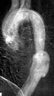 Aorta coarctatiok késői reoperációja