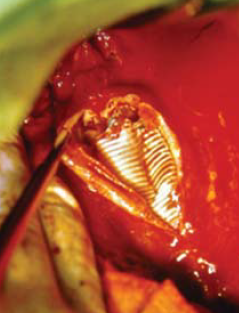 Aorta coarctatiok késői reoperációja