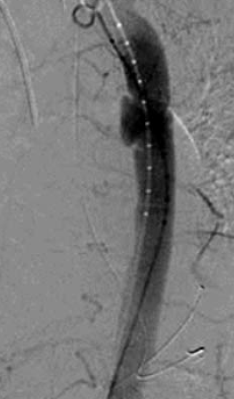 Sebészi megoldások krónikus multivisceralis arteriás elzáródások eseteiben