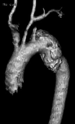 Sebészi megoldások krónikus multivisceralis arteriás elzáródások eseteiben