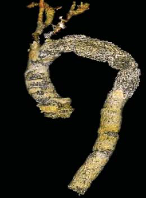 Sebészi megoldások krónikus multivisceralis arteriás elzáródások eseteiben