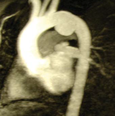 Sebészi megoldások krónikus multivisceralis arteriás elzáródások eseteiben