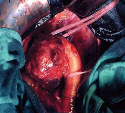 Sebészi megoldások krónikus multivisceralis arteriás elzáródások eseteiben