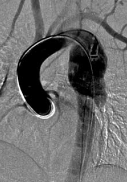 Sebészi megoldások krónikus multivisceralis arteriás elzáródások eseteiben