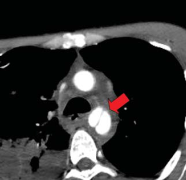 Sebészi megoldások krónikus multivisceralis arteriás elzáródások eseteiben