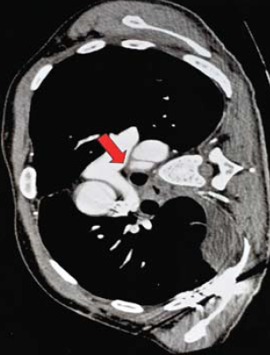 Sebészi megoldások krónikus multivisceralis arteriás elzáródások eseteiben