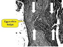 Elektrocoaptive éregyesítés - kombinált eljárások