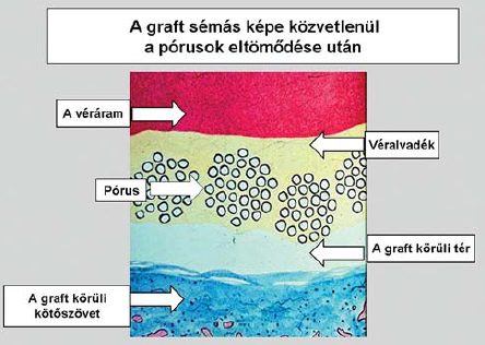 Még egyszer az érprotézisről, de tágabb értelemben-1. rész