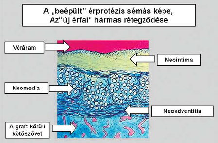 Még egyszer az érprotézisről, de tágabb értelemben-1. rész