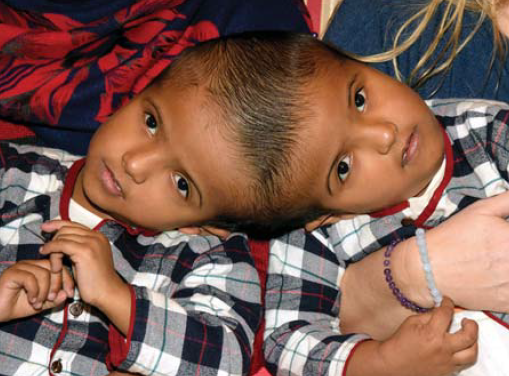 A bangladesi sziámi ikrek szétválasztása A bangladesi sziámi ikrek szétválasztása