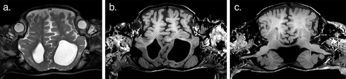A bangladesi sziámi ikrek szétválasztása A bangladesi sziámi ikrek szétválasztása