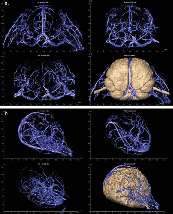 A bangladesi sziámi ikrek szétválasztása A bangladesi sziámi ikrek szétválasztása
