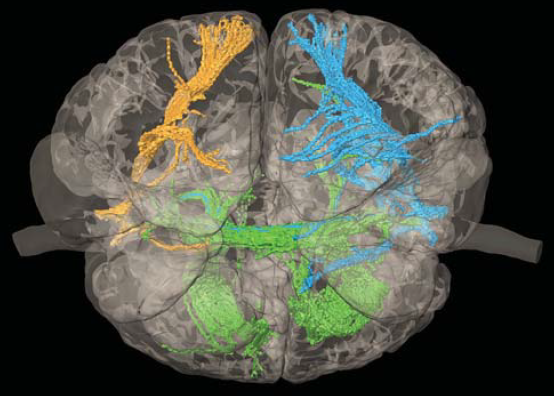 A bangladesi sziámi ikrek szétválasztása A bangladesi sziámi ikrek szétválasztása
