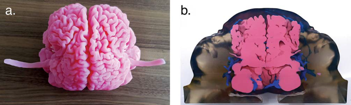 A bangladesi sziámi ikrek szétválasztása A bangladesi sziámi ikrek szétválasztása