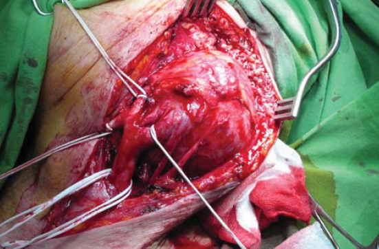 A Salgótarjáni Kórház Érsebészeti Osztályának története