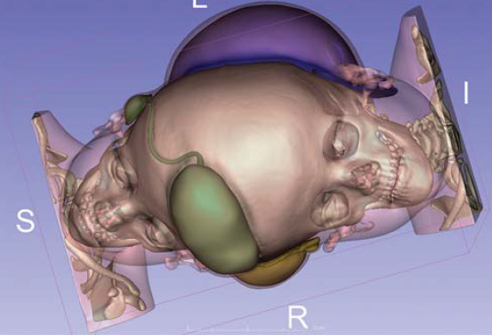 A bangladesi sziámi ikrek szétválasztása A bangladesi sziámi ikrek szétválasztása