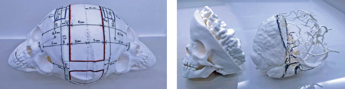 A bangladesi sziámi ikrek szétválasztása - II. rész