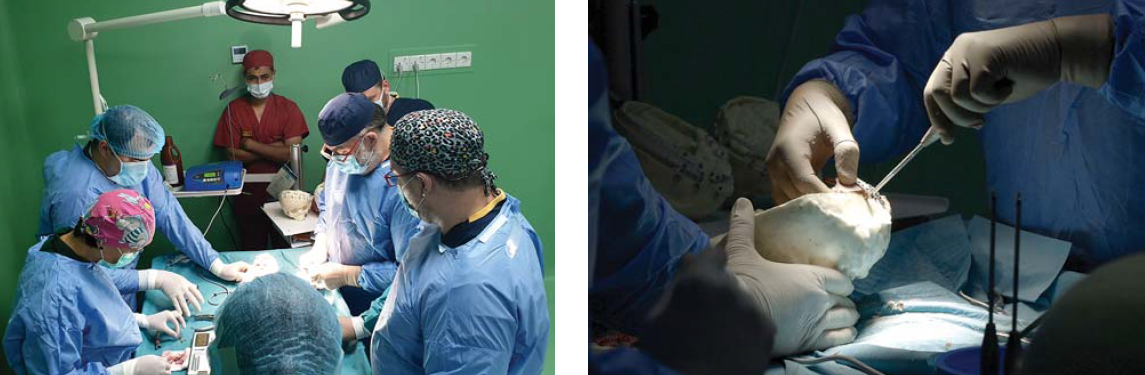 A bangladesi sziámi ikrek szétválasztása - II. rész