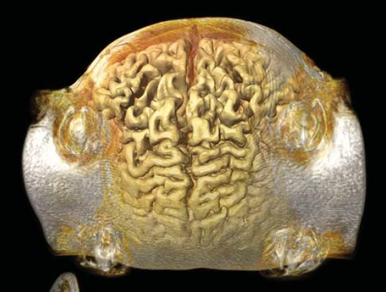 A bangladesi sziámi ikrek szétválasztása - II. rész