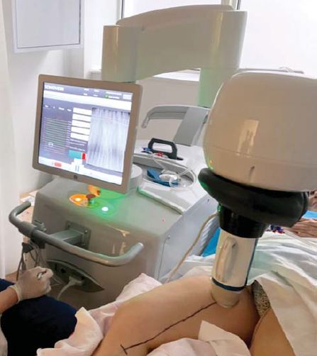 A Sonovein HIFU készüléke működés közben - a vena saphena magna kezelése