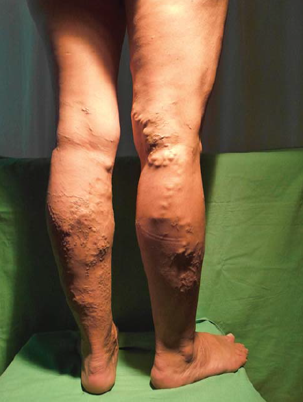 Lézeres crossectomia utáni kiújulás