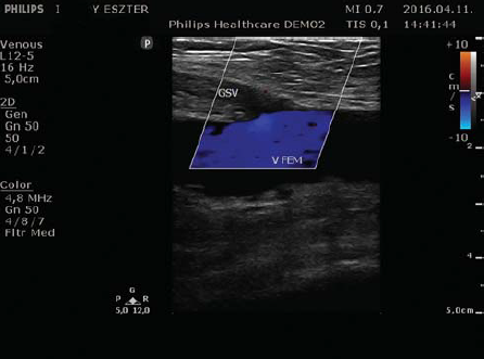 Lézeres crossectomia utáni kiújulás