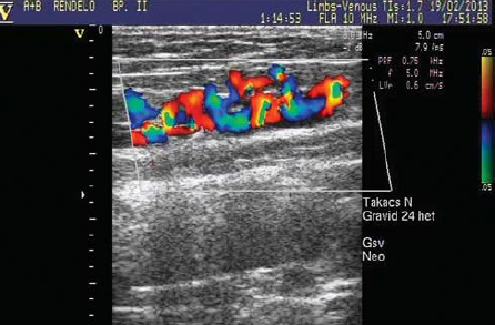 Lézeres crossectomia utáni kiújulás